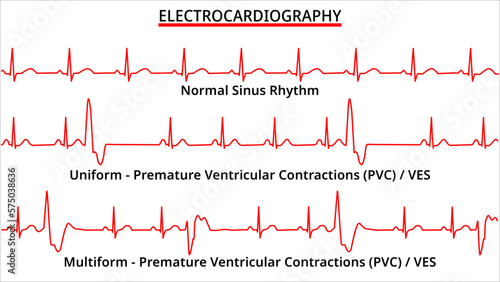 Set of ECG Common Abnormalities - Normal Sinus Rhythm - Uniform and Multiform Premature Ventricular Contractions (PVC) - Ventricle Extra Systole -  Electrocardiography Vector Medical Illustration