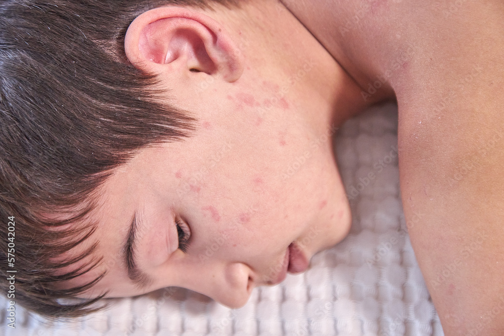 Skin itching, dermatitis, food allergy on the face. A boy with red