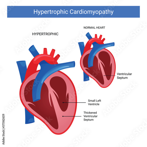 Hypertrophic cardiomyopathy, difference normal heart and hypertrophic