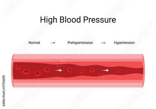 Vector illustration causes high blood pressure, design concept for medical
