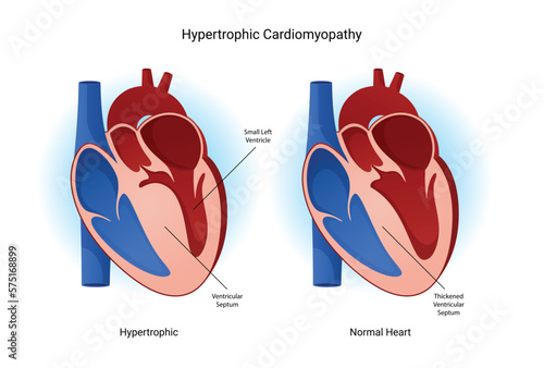 Infographic hypertrophic cardiomyopathy