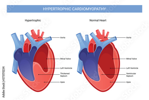 Hypertrophic cardiomyopathy infographic