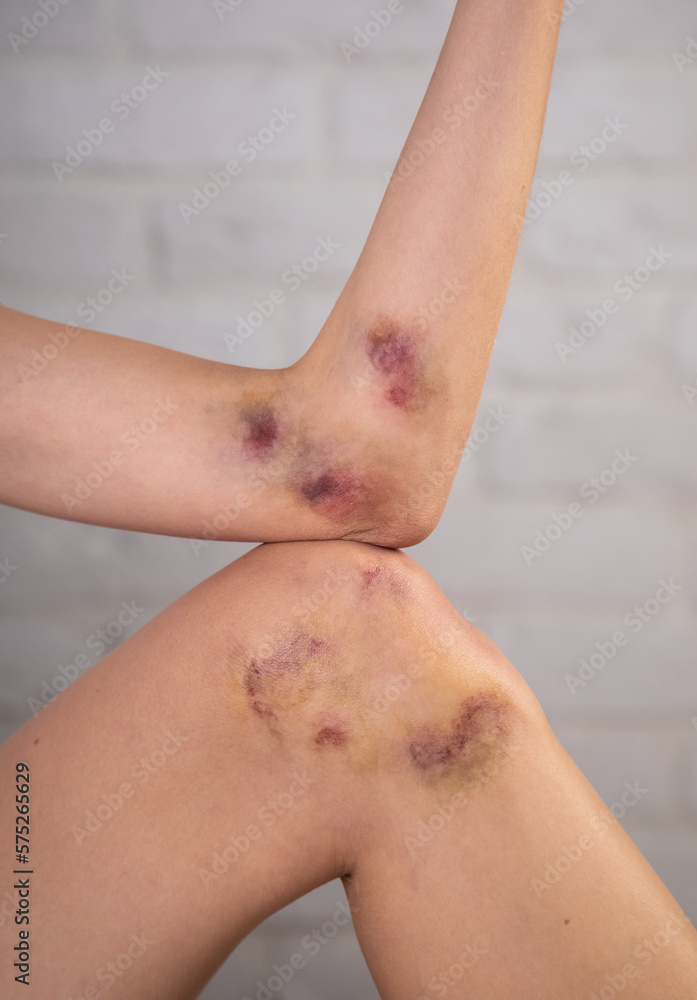 Fototapeta premium Close-up of bruises on the skin of an injured woman's arm and leg