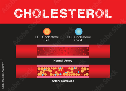 Cholesterol in artery, health risk , accumulation blood, Obesity, vector design