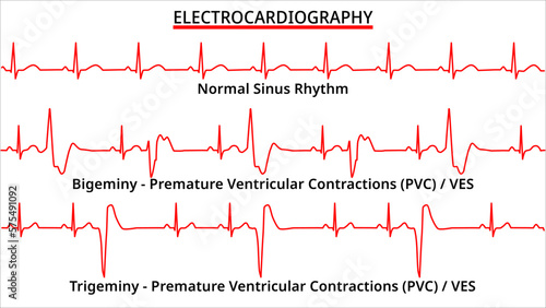 Set of ECG Common Abnormalities - Bigeminy vs Trigeminy Premature Ventricular Contractions (PVC) - Ventricle Extra Systole (VES) -  Electrocardiography Vector Medical Illustration