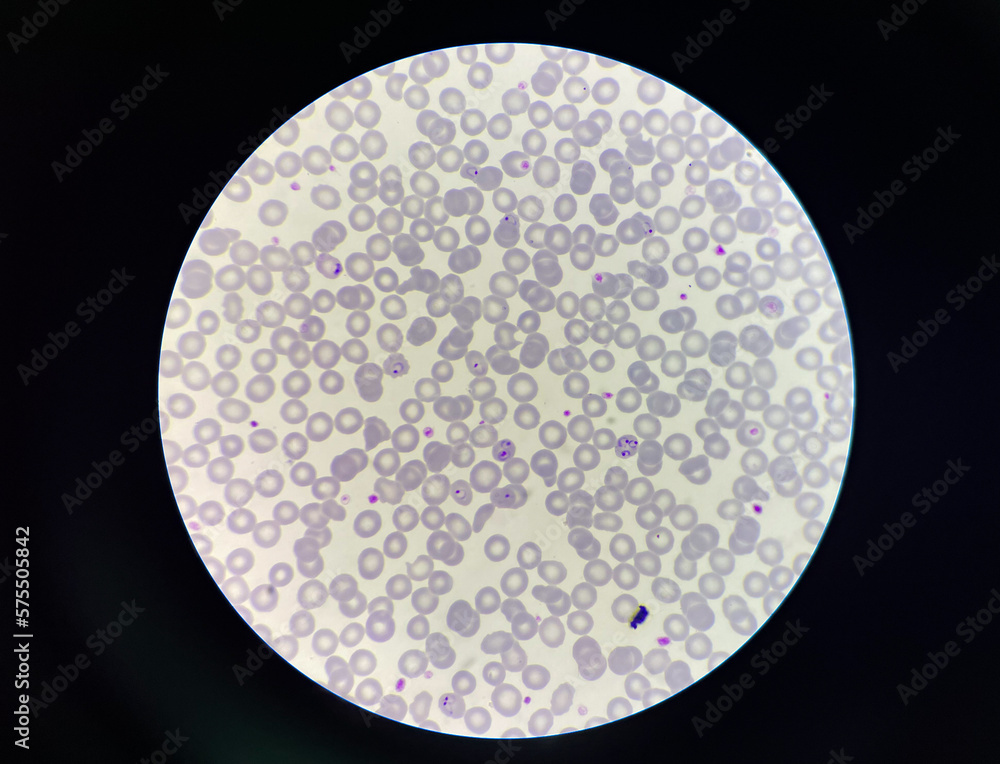 Malaria pigment blood parasite infected rbc. Malaria pigment blood parasite infected rbc.