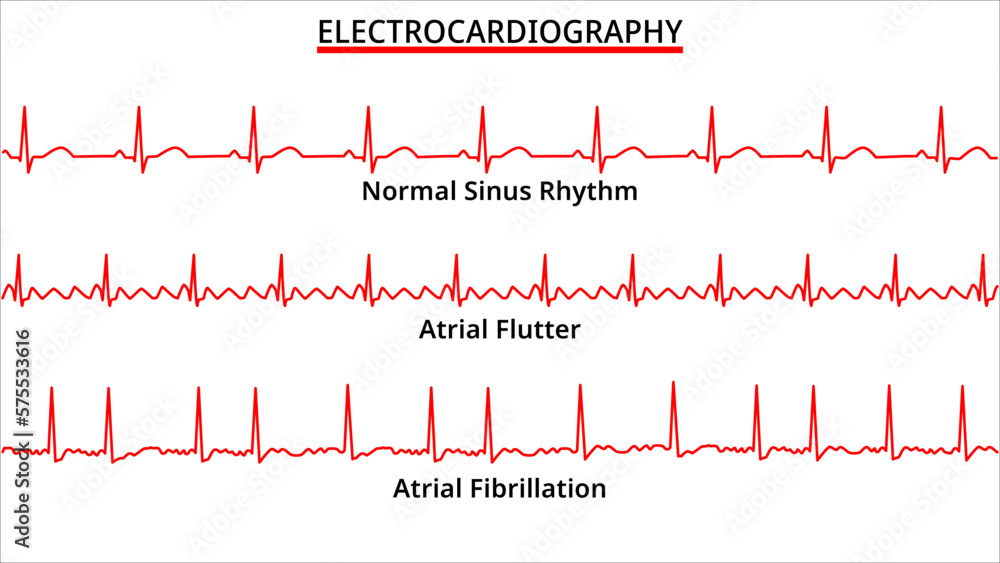 Obraz Set of ECG Common Abnormalities - Atrial Flutter vs Atrial ...