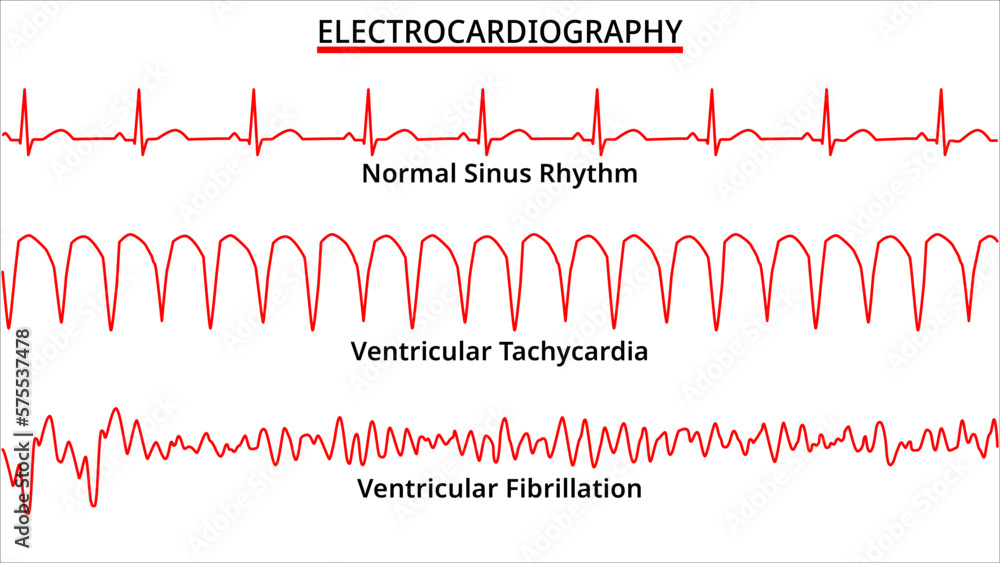 Vektorová Grafika Set Of Ecg Common Abnormalities Ventricular Vektorová Grafika Set Of Ecg Common Abnormalities Ventricular