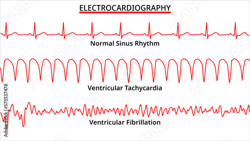 Set of ECG Common Abnormalities - Ventricular Tachycardia vs Ventricular Fibrillation - Normal Sinus Rhythm - Electrocardiography Vector Medical Illustration