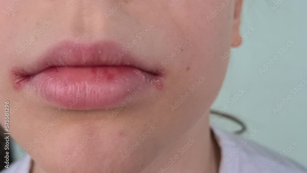 Sore on lip of child and peeling of skin. Herpes and vesicles on skin