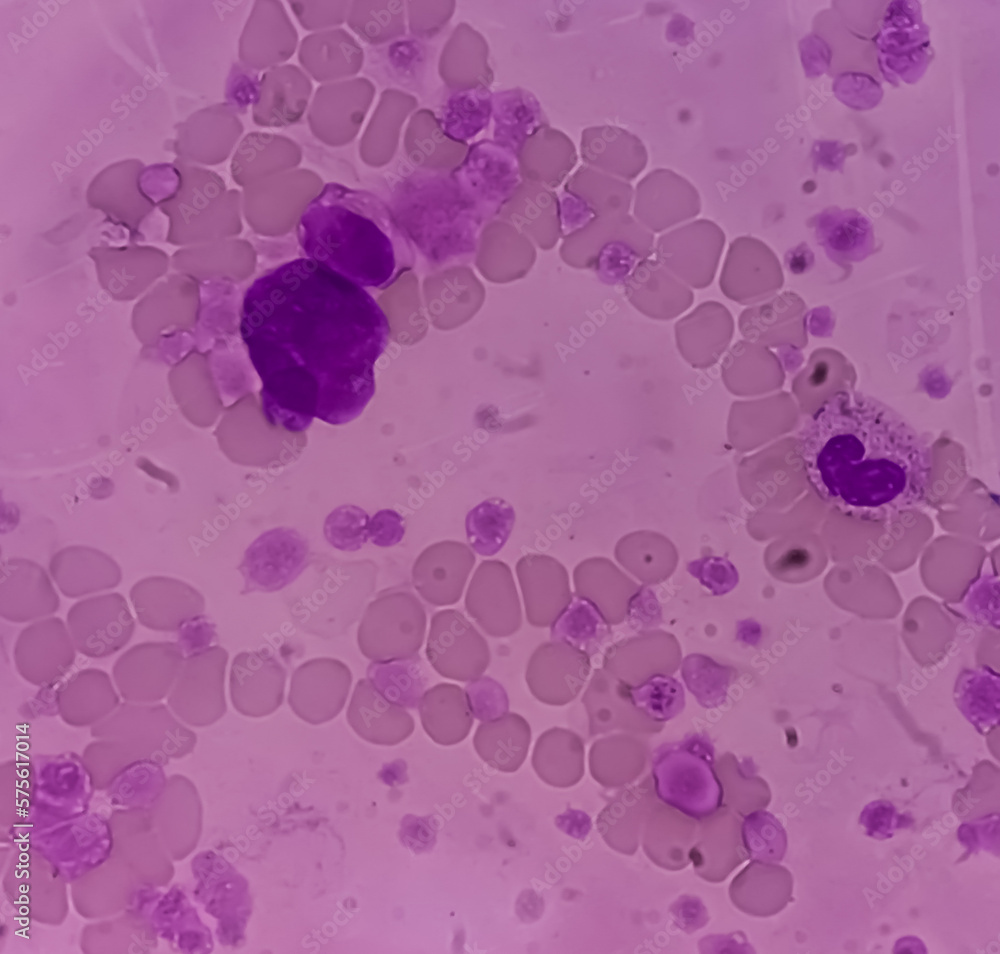 Chronic myeloid leukemia (CML) in accelerated phase also known as