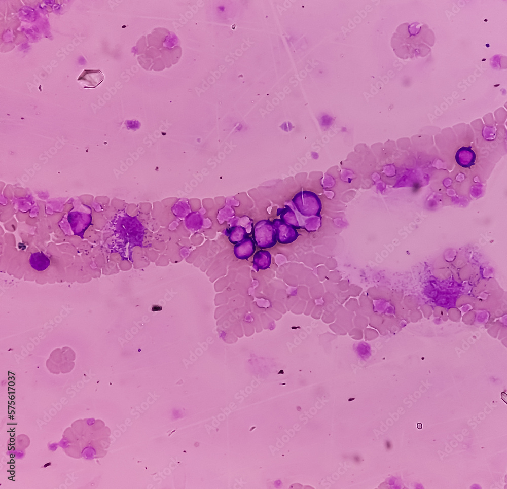 Chronic Myeloid Leukemia Cml In Accelerated Phase Also Known As Chronic Myeloid Leukemia Cml In Accelerated Phase Also Known As