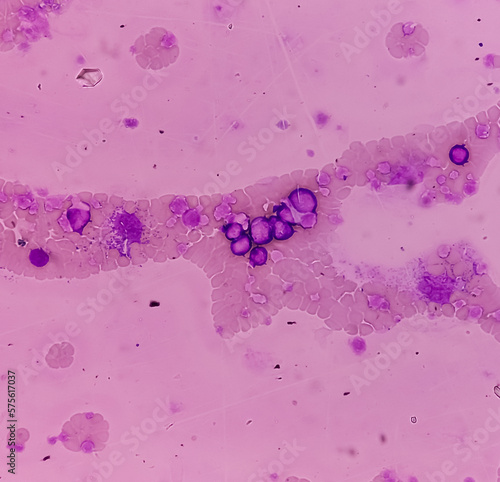 Chronic myeloid leukemia (CML) in accelerated phase also known as Chronic myelogenous leukemia. Thrombocytosis. Red blood cell. Blood smear. photo