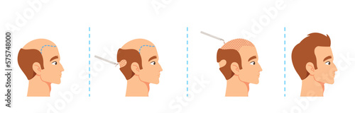 Hair Transplantation Procedure Stages, Male Scalp Before And After. Visual Aids For Medical Or Educational Materials