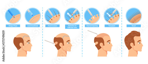 A Step-by-step Infographic To Hair Transplantation Procedure. Design Phase, Local Anesthesia, Punch Incision