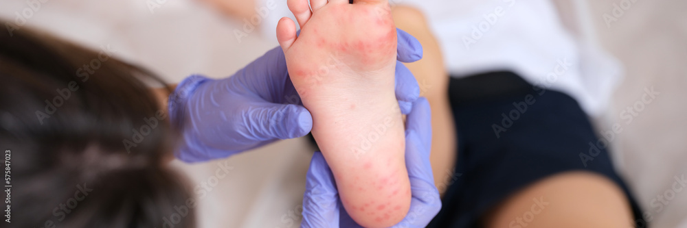 Fototapeta premium Doctor examines red rashes on feet of child closeup