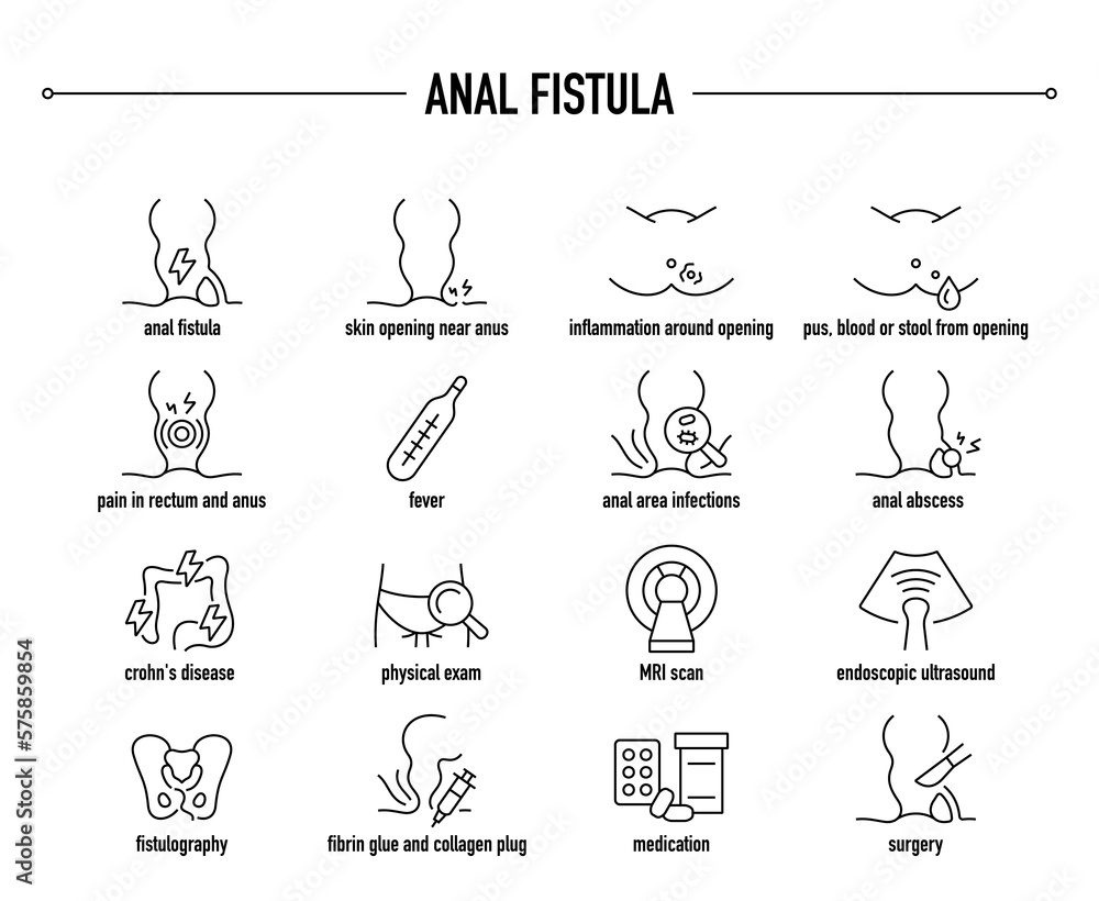 Anal Fistula symptoms, diagnostic and treatment vector icon set. Line editable medical icons.