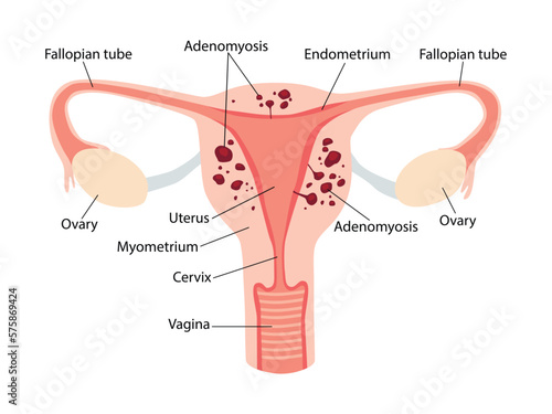 Anatomical illustration of the female reproductive system with the symptoms of adenomyosis, with annotations.