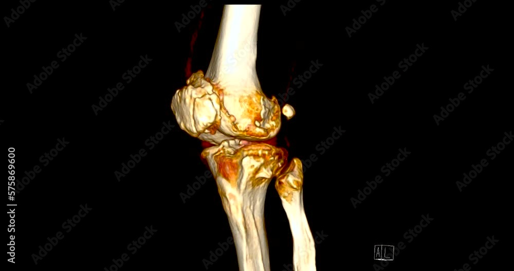 CT Scan of Knee joint 3D rendering showing fracture of lateral condyle of femur bone. CT Scan of Knee joint 3D rendering showing fracture of lateral condyle of femur bone.