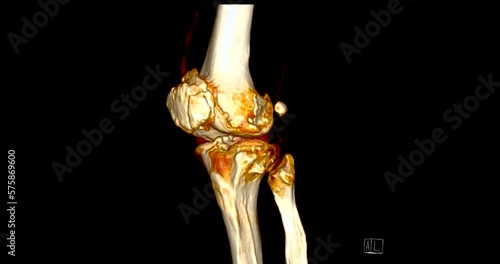 CT Scan of  Knee joint 3D rendering showing fracture of lateral condyle of femur bone. photo