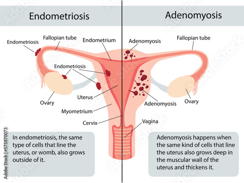 Anatomical illustration of the female reproductive system with the symptoms of adenomyosis and the symptoms of endometrioses, with annotations.