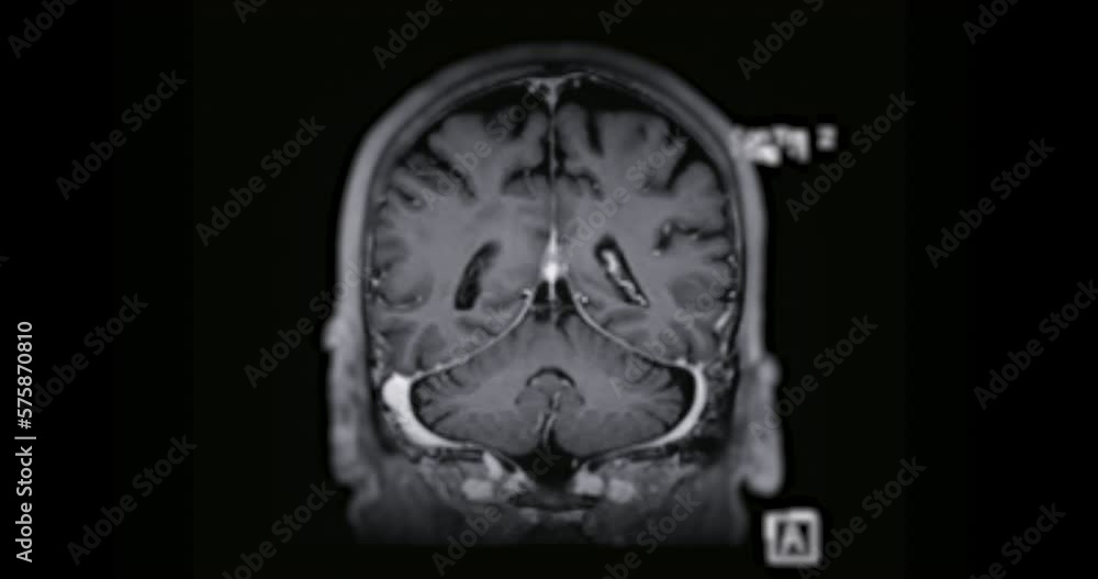 MRI Brain can help doctors look for conditions such as bleeding, swelling, tumors, infections