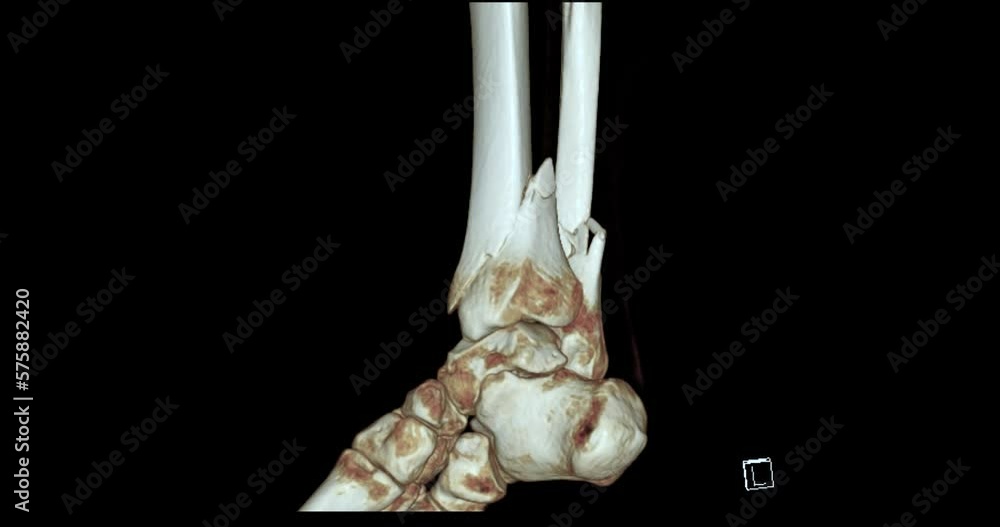 CT Scan of Ankle joint 3D rendering showing tibia and fibula bone ...