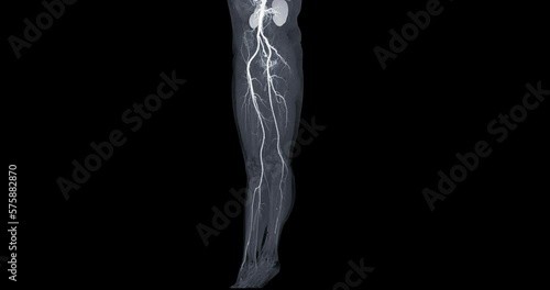 CTA femoral artery run off showing  femoral artery for diagnostic  Acute or Chronic Peripheral Arterial Disease. photo
