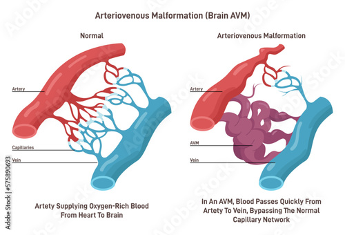 Brain AVM. Tangled blood vessels that connects arteries and veins