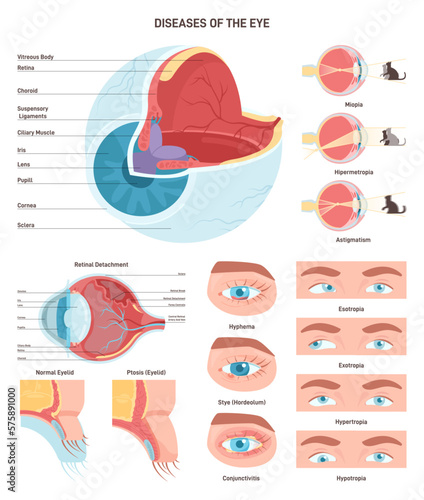 Human eye diseases set. Human vision organ, eyesight and eyelid problem.