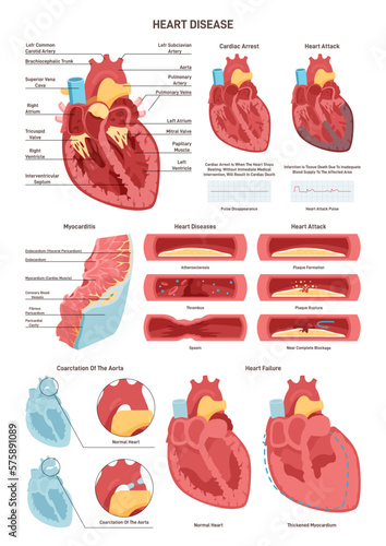 Heart diseases set. Anatomy of the heart and surrounding blood vessels.