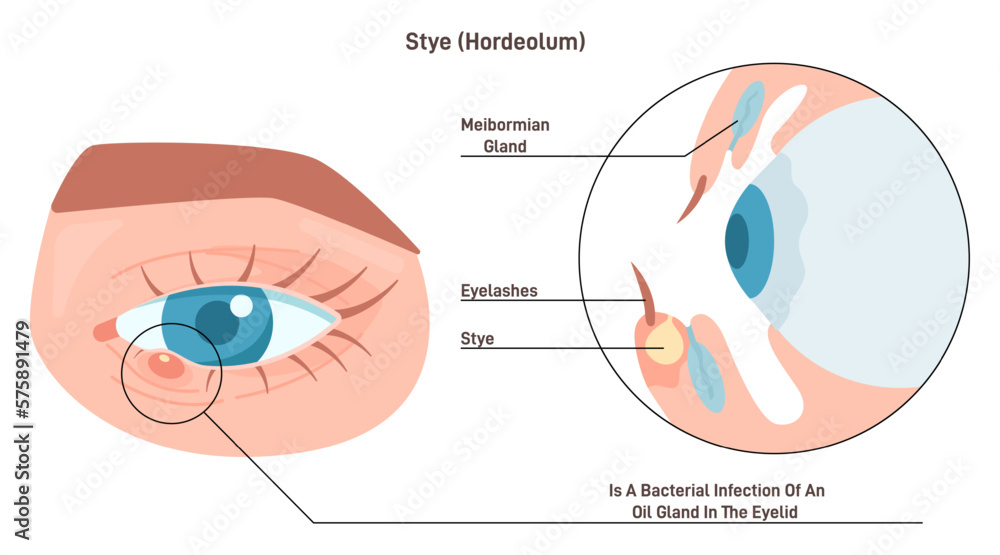 Eye stye or hordeolum. Red, painful lump near the edge of the eyelid