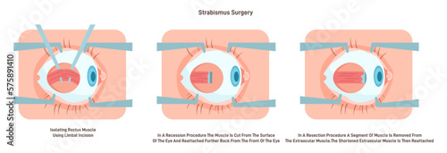 Strabismus surgery. Eye muscle recession, cutting the muscle