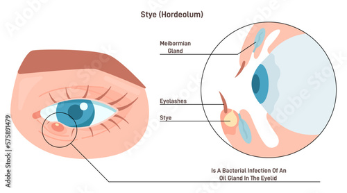 Eye stye or hordeolum. Red, painful lump near the edge of the eyelid.