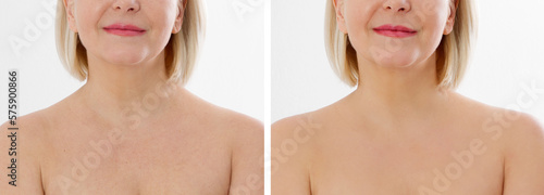 Closeup banner before after neckline middle age woman skin. Before-after skincare aged spots. Menopause beauty Healthcare. Neck line wrinkled skin anti-aging spa treatment. Female elderly senior tags