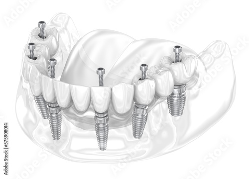 Dental prosthesis supported by six implants. Dental 3D illustration photo