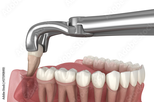 Canvas Print Extraction of wisdom tooth