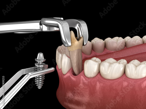 Tooth extraction and implantation, complex immediate surgery. Dental 3D illustration photo