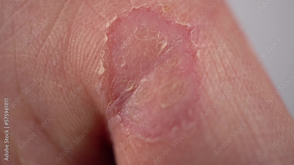 Fototapeta premium Male hand with callus on the finger close-up. Wart on hand. The skin of the hands lacks vitamins. Macro.