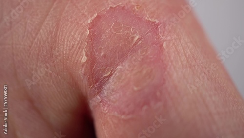Male hand with callus on the finger close-up. Wart on hand. The skin of the hands lacks vitamins. Macro.