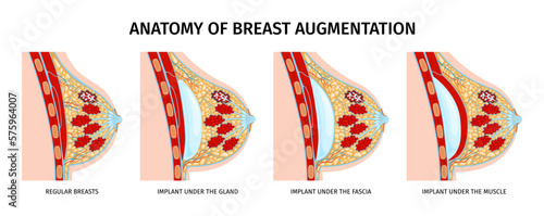 Breast Anatomy Implants Set