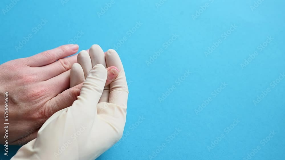 A doctor in gloves examines the affected nails of the patient - onycholysis close-up .Separation of the nail plate from the nail bed after manicure. The concept of healthy lifestyle, podology. A doctor in gloves examines the affected nails of the patient - onycholysis close-up .Separation of the nail plate from the nail bed after manicure. The concept of healthy lifestyle, podology.