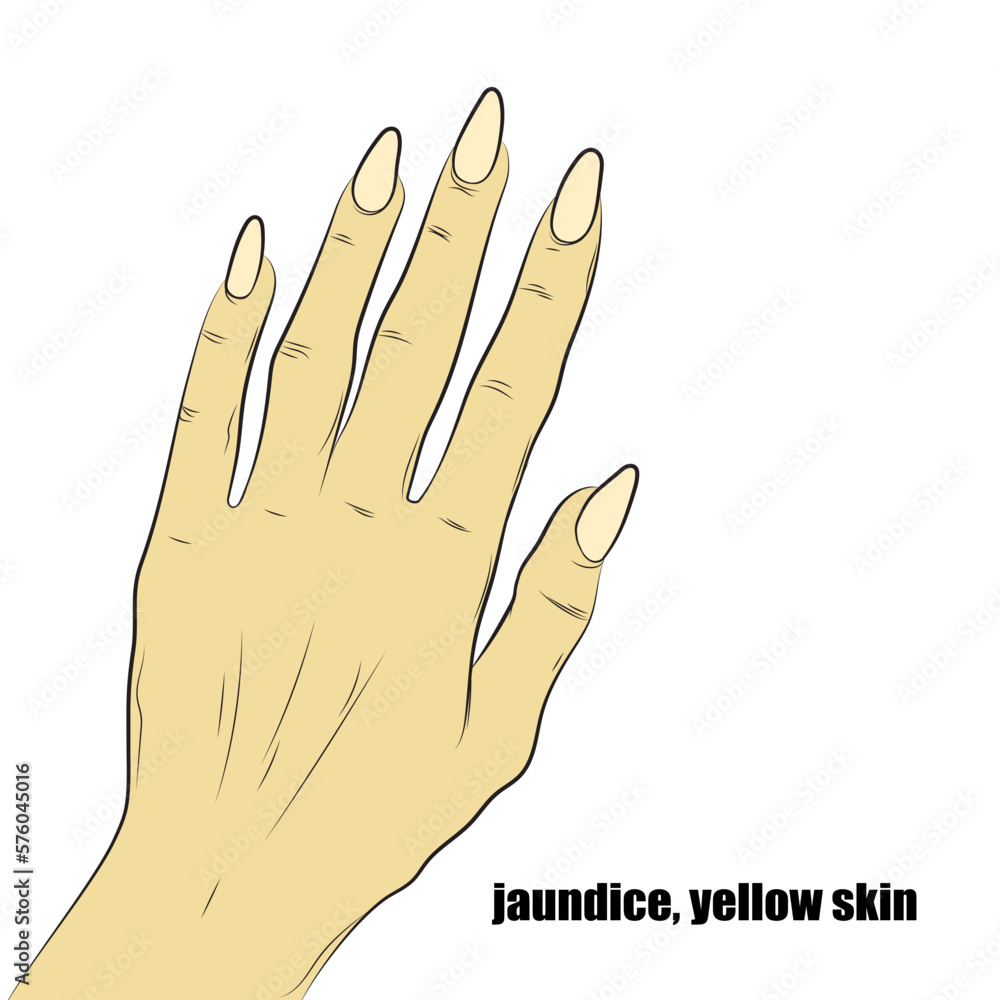 Obraz premium Jaundice, yellowish skin caused by the accumulation of bilirubin in the blood.