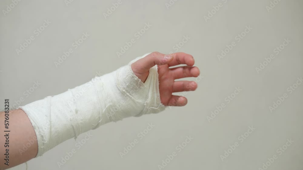 Man with plaster cast on arm. A broken arm in plaster. Man with plaster cast on arm. A broken arm in plaster.
