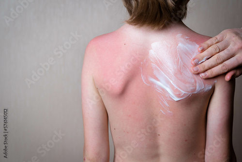 sunburn, red skin of the child's back, hand lubricates inflamed skin with a soothing cream