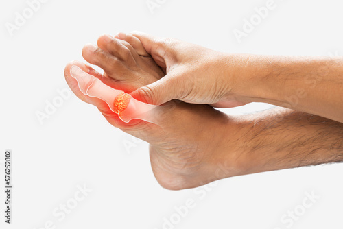 Gout or inflammatory arthritis.