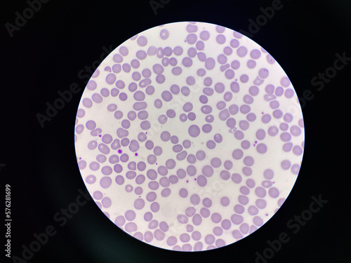 Abnormal red blood cells morphology macrocyte.