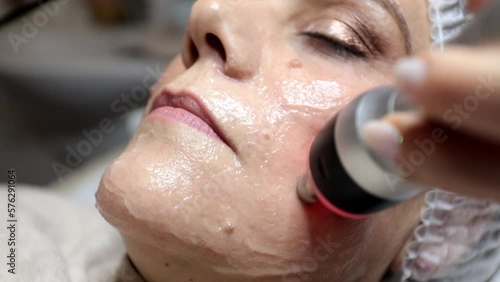 Beautician performs facial radiofrequency application for melasma treatment in a female patient. Beauty salon treatment.