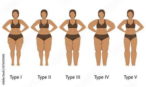 Women's body in different types of Lipedema photo