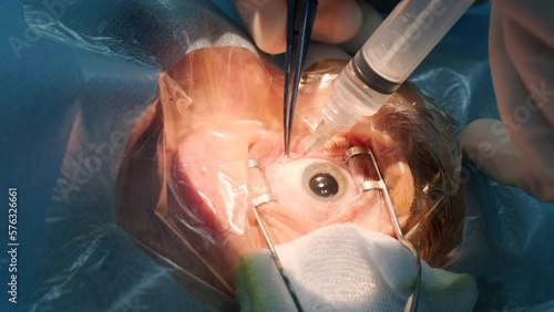 Eye surgery, vitreoretinal. Vitrectomy surgery. photo